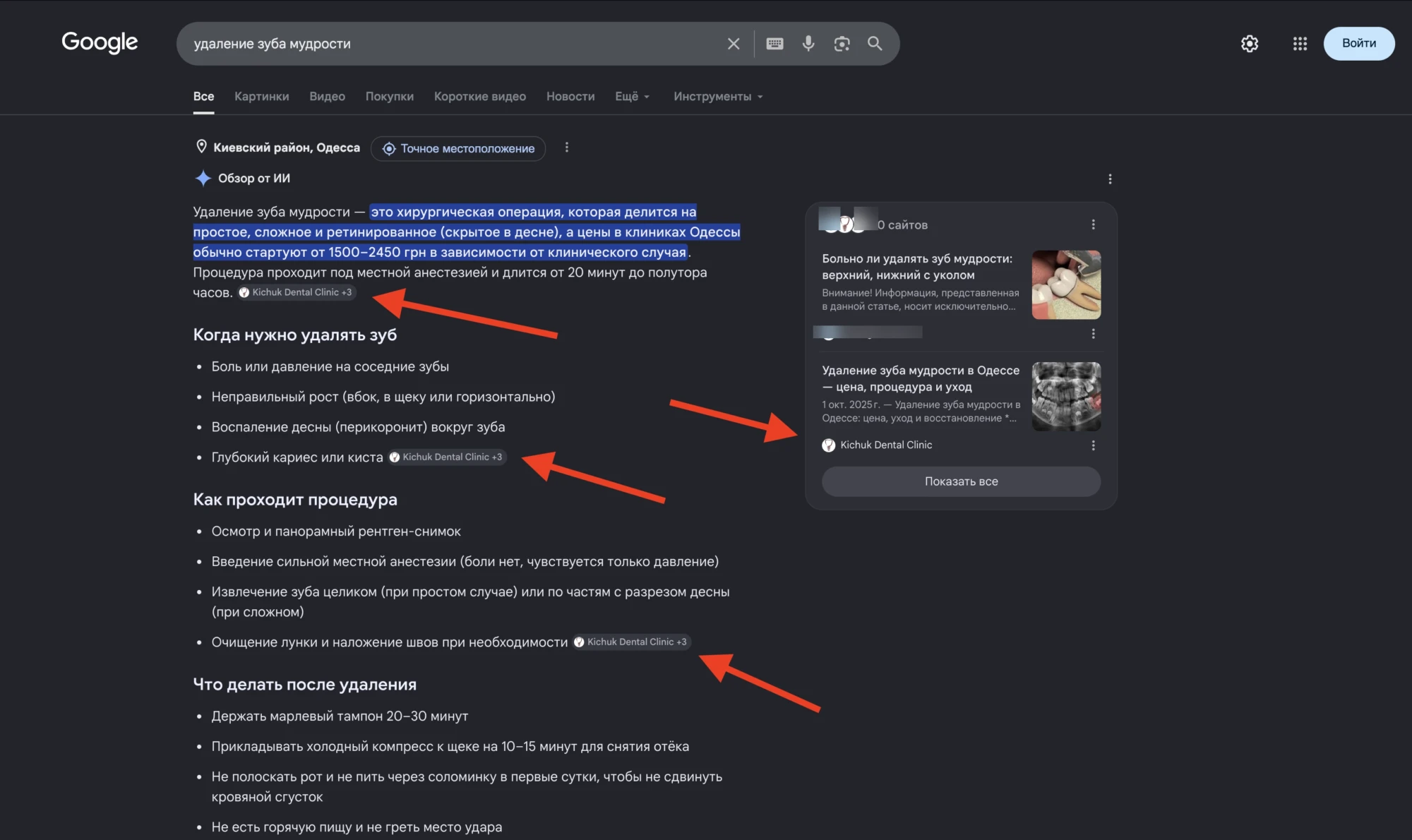 Рекомендація сайту клініки в Google AI Overview за запитом "видалення зуба мудрості"